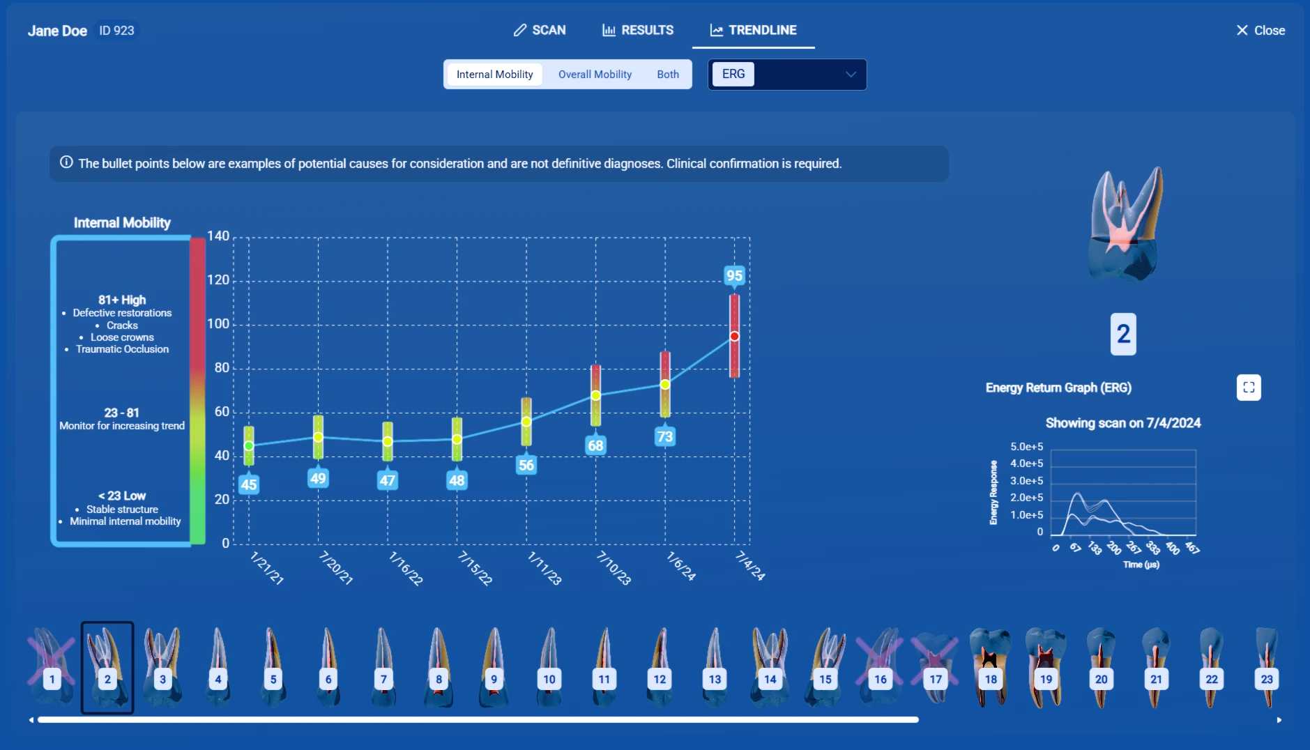 InnerView trendline showing internal mobility for one tooth rising from 45 to 95 across visits, with its energy return graph
