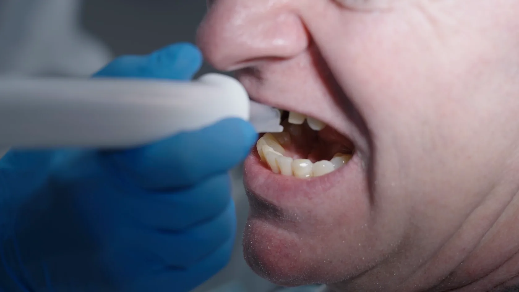 InnerView handpiece measuring a patient’s restored tooth